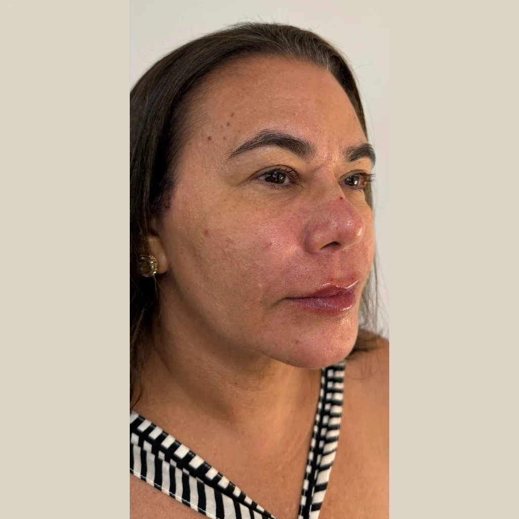 Depois do Minilift e Contorno