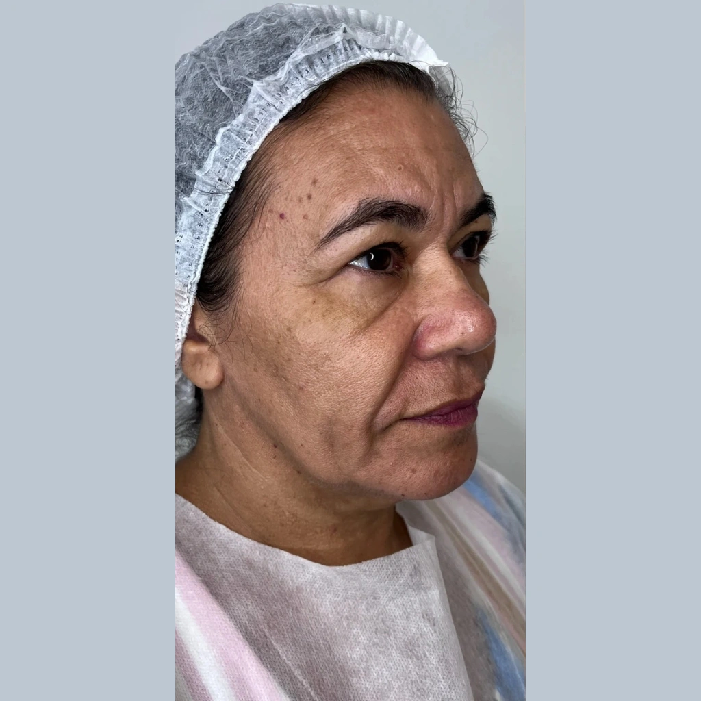 Antes do Minilift e Contorno
